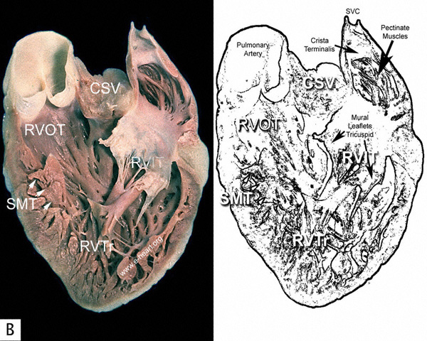 Right Ventricle Lateral